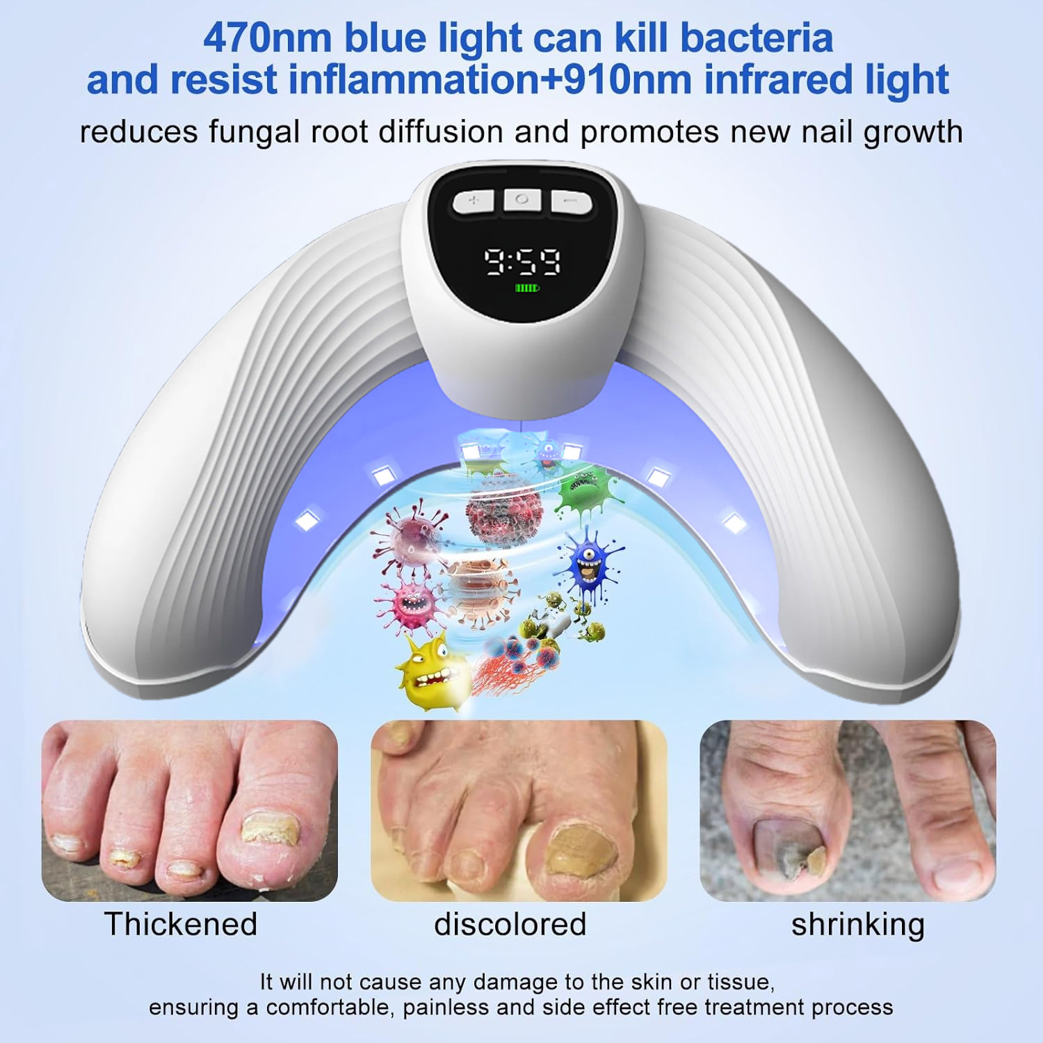 Laser Nail Fungus Treatment De - Industrial Laser Removal ulasan dan harga